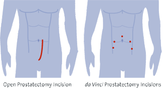 Illustration of the da vinci incision for prostate gland surgery