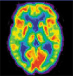 Sample PET Scan